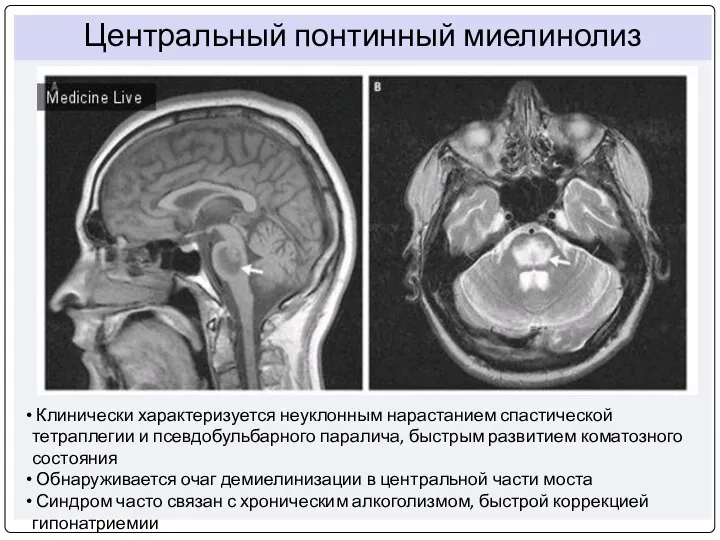 Клинически характеризуется неуклонным нарастанием спастической тетраплегии и псевдобульбарного паралича, быстрым развитием коматозного