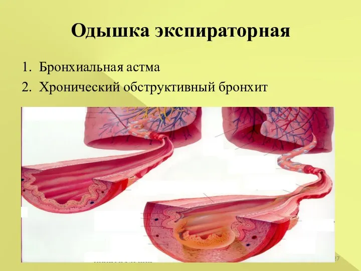 1. Бронхиальная астма 2. Хронический обструктивный бронхит Одышка экспираторная *