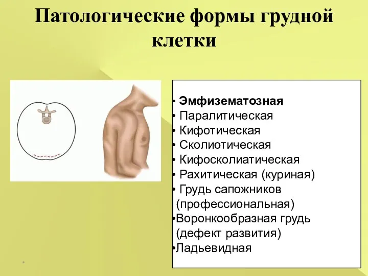 Патологические формы грудной клетки * Эмфизематозная Паралитическая Кифотическая Сколиотическая Кифосколиатическая Рахитическая (куриная)