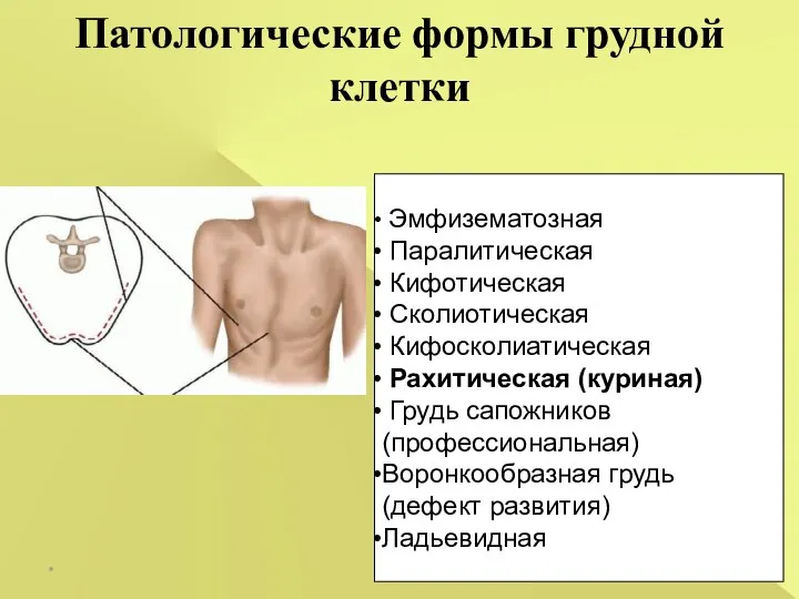 Патологические формы грудной клетки * Эмфизематозная Паралитическая Кифотическая Сколиотическая Кифосколиатическая Рахитическая (куриная)