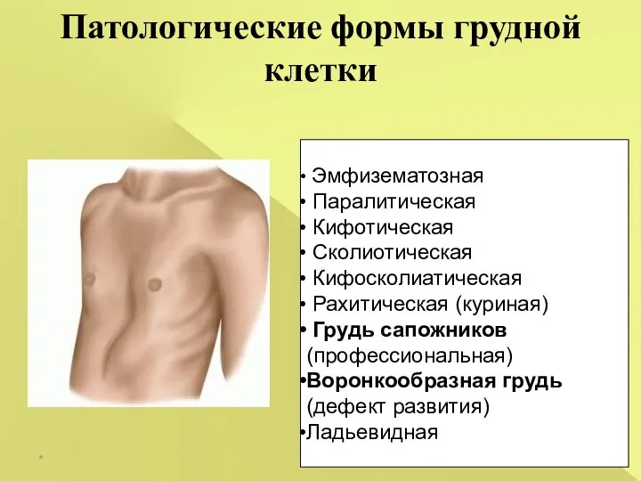 Патологические формы грудной клетки * Эмфизематозная Паралитическая Кифотическая Сколиотическая Кифосколиатическая Рахитическая (куриная)