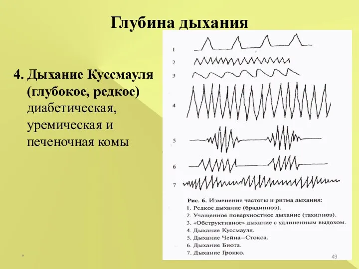 * Глубина дыхания 4. Дыхание Куссмауля (глубокое, редкое) диабетическая, уремическая и печеночная комы