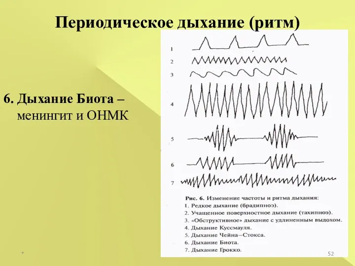 * Периодическое дыхание (ритм) 6. Дыхание Биота – менингит и ОНМК