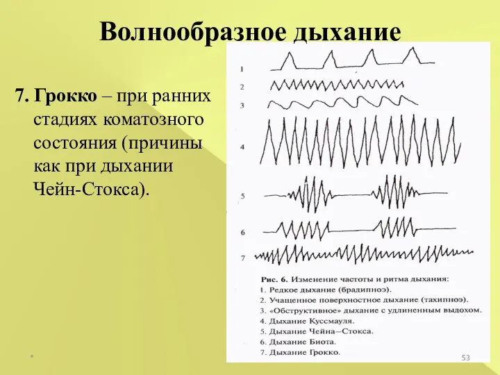 * Волнообразное дыхание 7. Грокко – при ранних стадиях коматозного состояния (причины как при дыхании Чейн-Стокса).