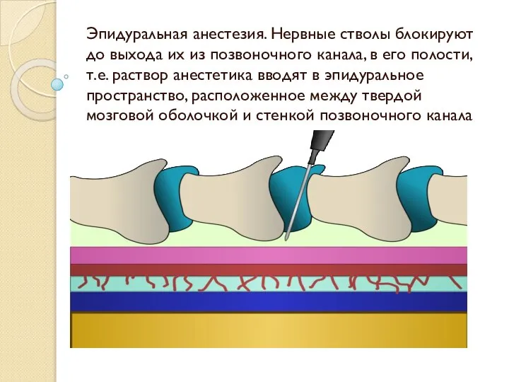 Эпидуральная анестезия. Нервные стволы блокируют до выхода их из позвоночного канала, в