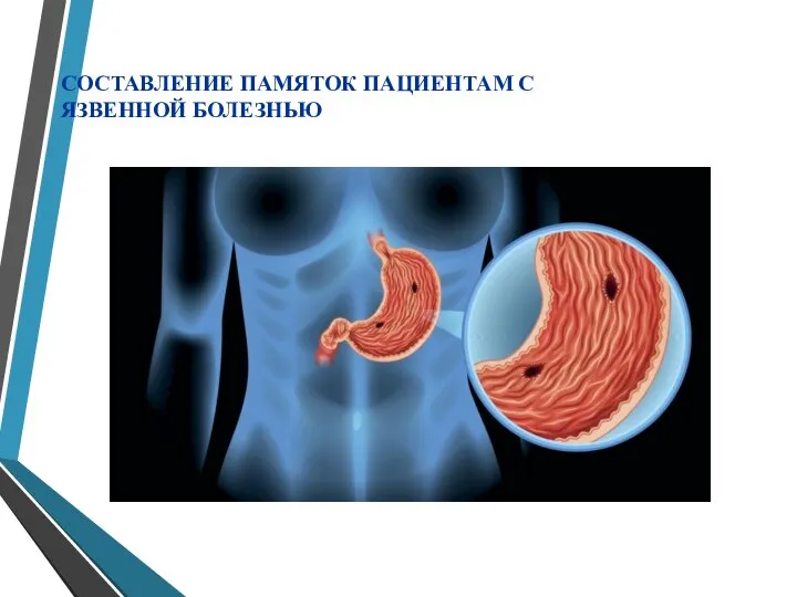 СОСТАВЛЕНИЕ ПАМЯТОК ПАЦИЕНТАМ С ЯЗВЕННОЙ БОЛЕЗНЬЮ