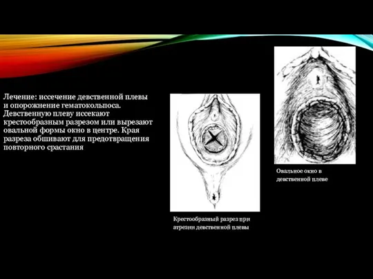 Лечение: иссечение девственной плевы и опорожнение гематокольпоса. Девственную плеву иссекают крестообразным разрезом