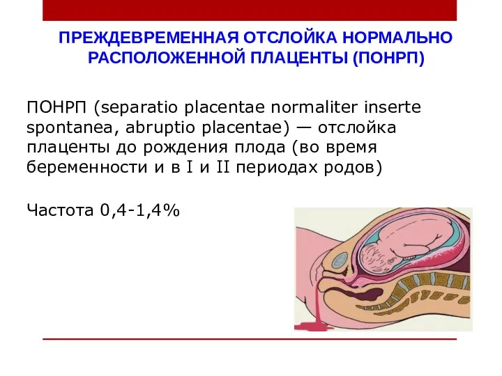 ПРЕЖДЕВРЕМЕННАЯ ОТСЛОЙКА НОРМАЛЬНО РАСПОЛОЖЕННОЙ ПЛАЦЕНТЫ (ПОНРП) ПОНРП (separatio placentae normaliter inserte spontanea,