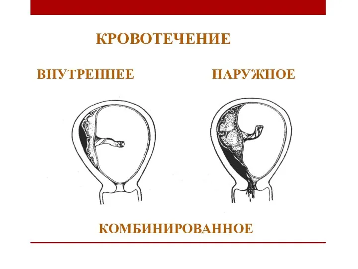 КРОВОТЕЧЕНИЕ ВНУТРЕННЕЕ НАРУЖНОЕ КОМБИНИРОВАННОЕ