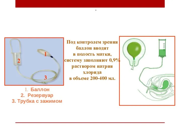 . 1. Баллон 2. Резервуар 3. Трубка с зажимом Под контролем зрения