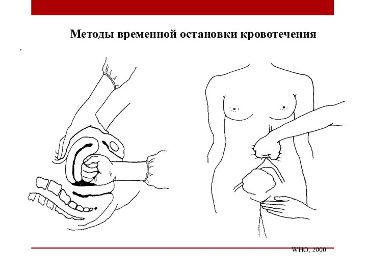 Методы временной остановки кровотечения WHO, 2000 .