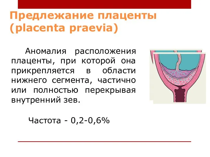 Предлежание плаценты (placenta praevia) Аномалия расположения плаценты, при которой она прикрепляется в