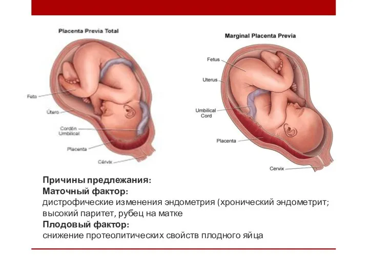 Причины предлежания: Маточный фактор: дистрофические изменения эндометрия (хронический эндометрит; высокий паритет, рубец