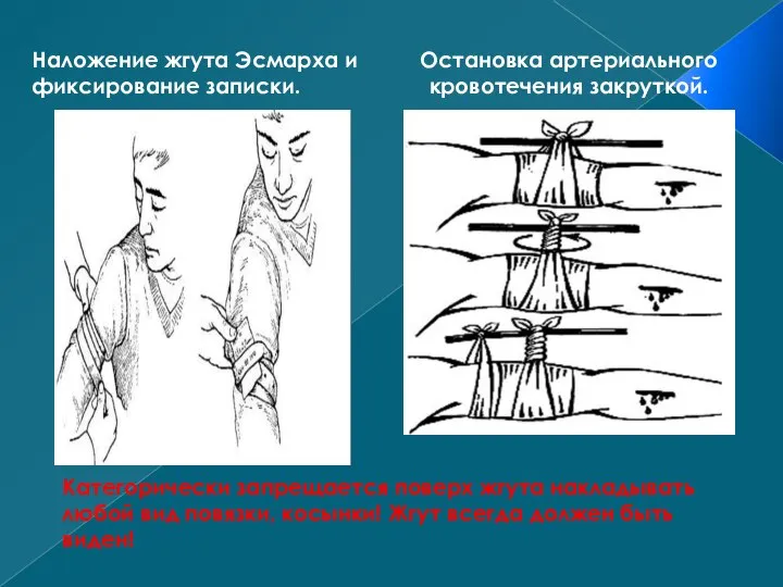 Категорически запрещается поверх жгута накладывать любой вид повязки, косынки! Жгут всегда должен