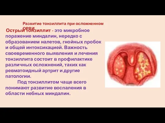 Развитие тонзиллита при осложненном ОРВИ Острый тонзиллит - это микробное поражение миндалин,