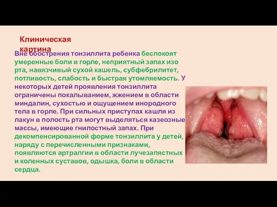 Клиническая картина Вне обострения тонзиллита ребенка беспокоят умеренные боли в горле, неприятный