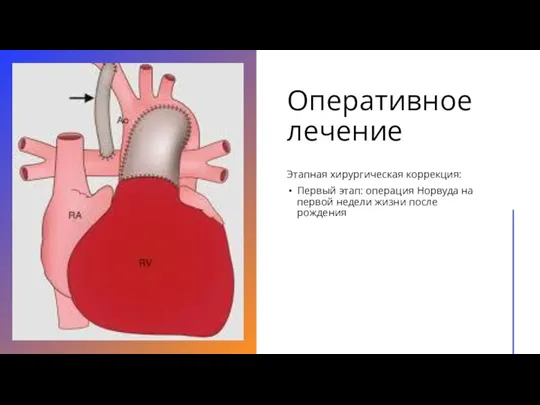 Оперативное лечение Этапная хирургическая коррекция: Первый этап: операция Норвуда на первой недели жизни после рождения