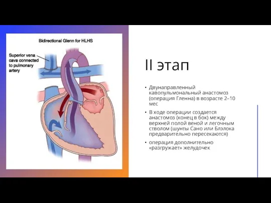 II этап Двунаправленный кавопульмональный анастомоз (операция Гленна) в возрасте 2–10 мес В