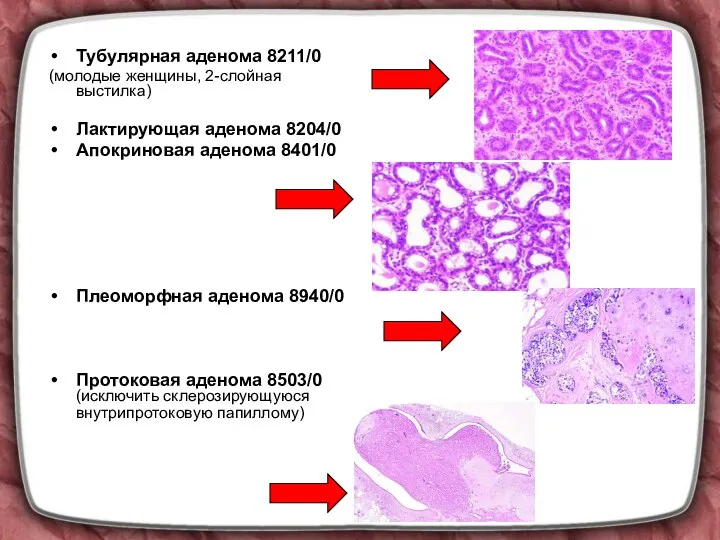 Тубулярная аденома 8211/0 (молодые женщины, 2-слойная выстилка) Лактирующая аденома 8204/0 Апокриновая аденома