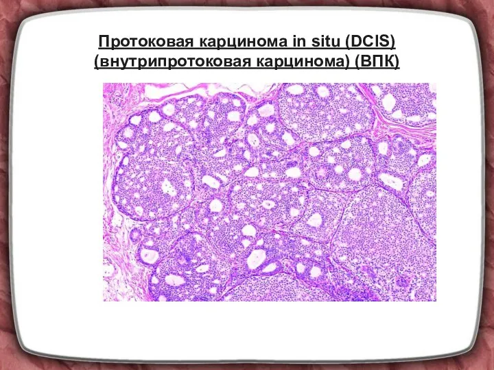 Протоковая карцинома in situ (DCIS) (внутрипротоковая карцинома) (ВПК)