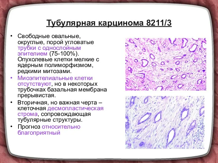 Тубулярная карцинома 8211/3 Свободные овальные, округлые, порой угловатые трубки с однослойным эпителием