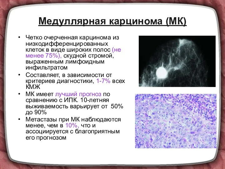 Медуллярная карцинома (МК) Четко очерченная карцинома из низкодифференцированных клеток в виде широких