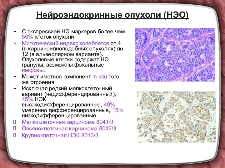 Нейроэндокринные опухоли (НЭО) С экспрессией НЭ маркеров более чем 50% клеток опухоли