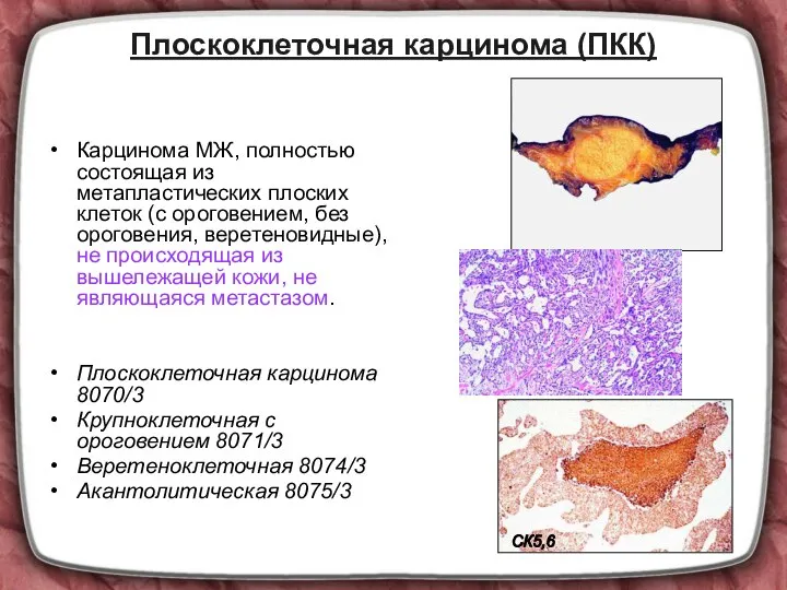 Плоскоклеточная карцинома (ПКК) Карцинома МЖ, полностью состоящая из метапластических плоских клеток (с