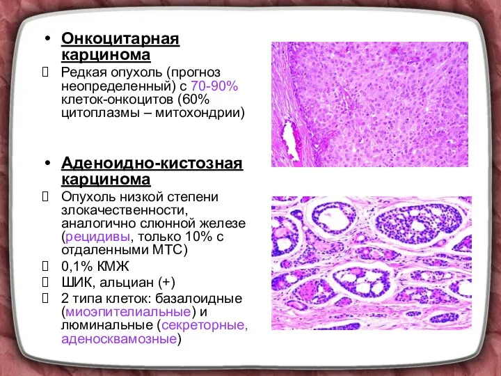 Онкоцитарная карцинома Редкая опухоль (прогноз неопределенный) с 70-90% клеток-онкоцитов (60% цитоплазмы –