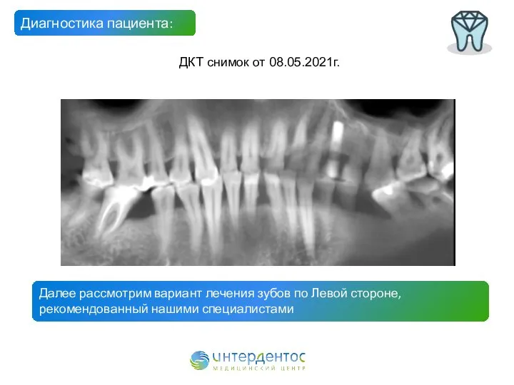 Диагностика пациента: ДКТ снимок от 08.05.2021г. Далее рассмотрим вариант лечения зубов по