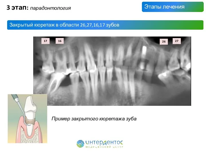 Этапы лечения Закрытый кюретаж в области 26,27,16,17 зубов 3 этап: парадонтология Пример