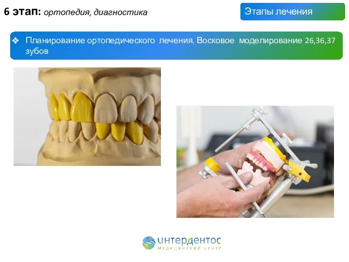 Этапы лечения Планирование ортопедического лечения. Восковое моделирование 26,36,37 зубов 6 этап: ортопедия, диагностика