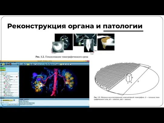 Реконструкция органа и патологии