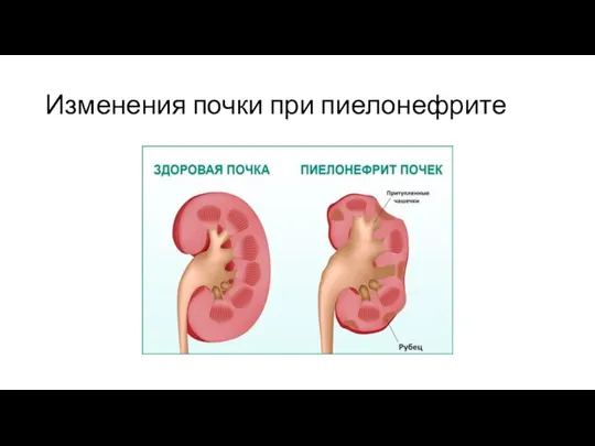 Изменения почки при пиелонефрите