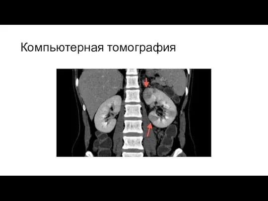 Компьютерная томография