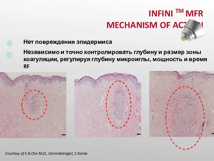 INFINI TM MFR MECHANISM OF ACTION Нет повреждения эпидермиса Независимо и точно