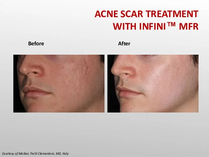 ACNE SCAR TREATMENT WITH INFINI™ MFR Courtesy of Matteo Tretti Clementoni, MD, Italy Before After