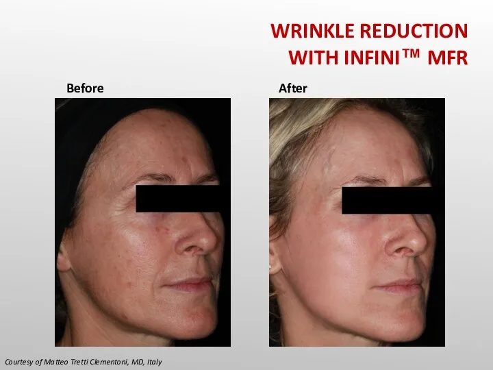 Courtesy of Matteo Tretti Clementoni, MD, Italy Before After WRINKLE REDUCTION WITH INFINI™ MFR