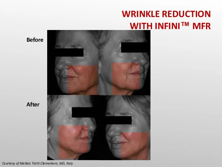 Courtesy of Matteo Tretti Clementoni, MD, Italy Before After WRINKLE REDUCTION WITH INFINI™ MFR