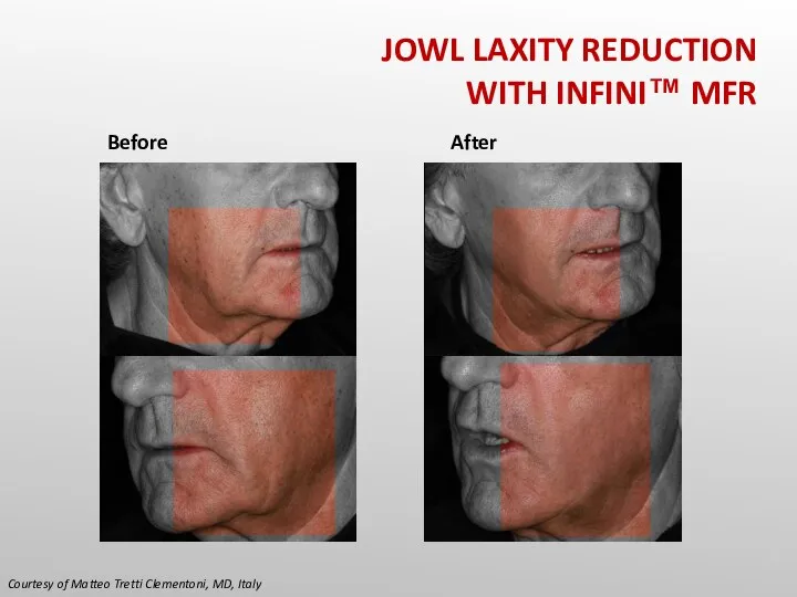 Courtesy of Matteo Tretti Clementoni, MD, Italy Before After JOWL LAXITY REDUCTION WITH INFINI™ MFR