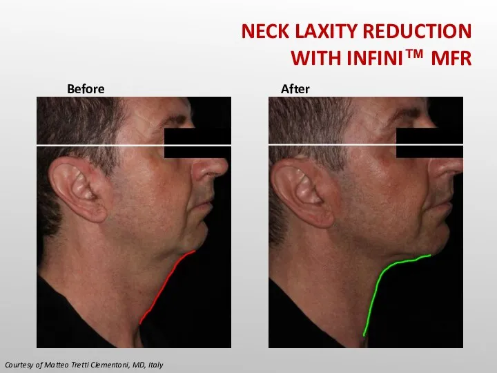 Courtesy of Matteo Tretti Clementoni, MD, Italy Before After NECK LAXITY REDUCTION WITH INFINI™ MFR