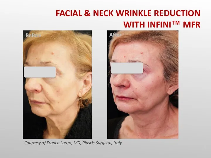 Before After Courtesy of Franco Lauro, MD, Plastic Surgeon, Italy FACIAL &