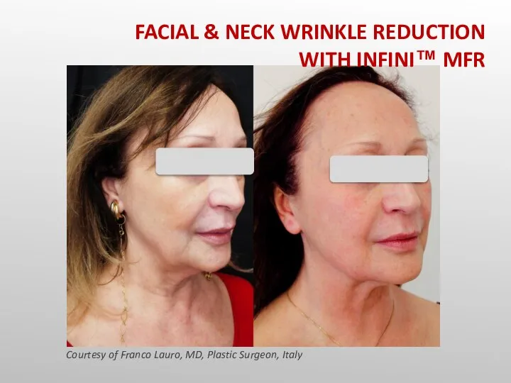 Courtesy of Franco Lauro, MD, Plastic Surgeon, Italy FACIAL & NECK WRINKLE REDUCTION WITH INFINI™ MFR