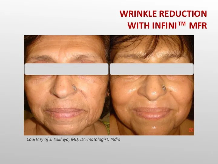 Courtesy of J. Sakhiya, MD, Dermatologist, India WRINKLE REDUCTION WITH INFINI™ MFR
