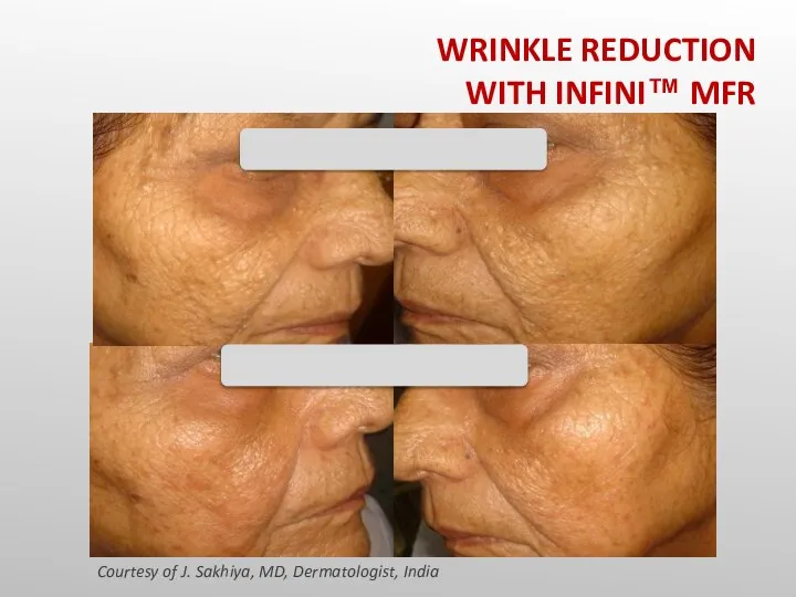 Courtesy of J. Sakhiya, MD, Dermatologist, India WRINKLE REDUCTION WITH INFINI™ MFR