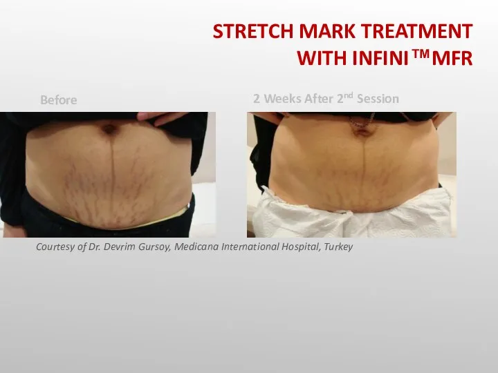 STRETCH MARK TREATMENT WITH INFINI™MFR Before Courtesy of Dr. Devrim Gursoy, Medicana