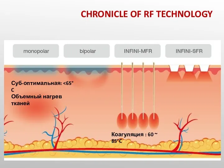 Суб-оптимальная: Объемный нагрев тканей Коагуляция : 60 ~ 85°C CHRONICLE OF RF TECHNOLOGY