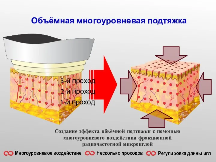 Объёмная многоуровневая подтяжка Создание эффекта объёмной подтяжки с помощью многоуровневого воздействия фракционной