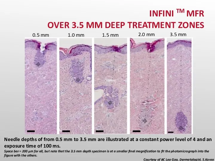 Needle depths of from 0.5 mm to 3.5 mm are illustrated at