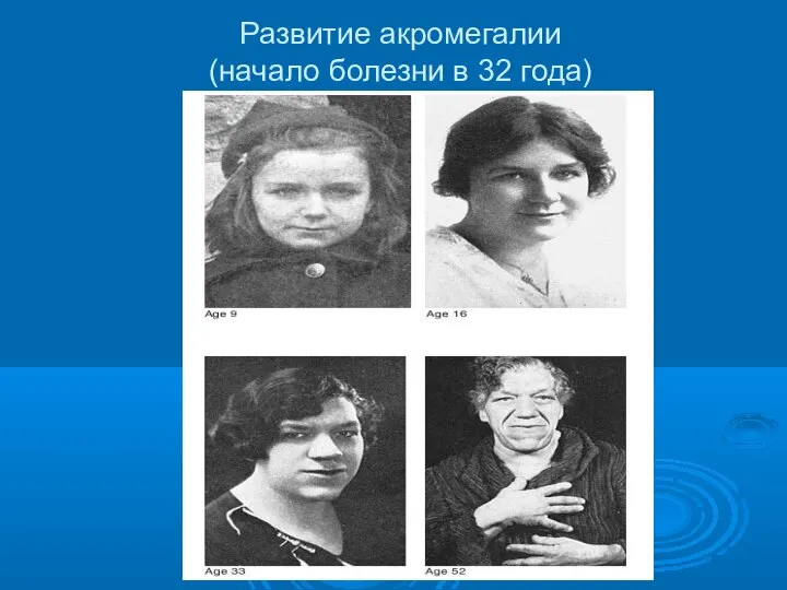 Развитие акромегалии (начало болезни в 32 года)